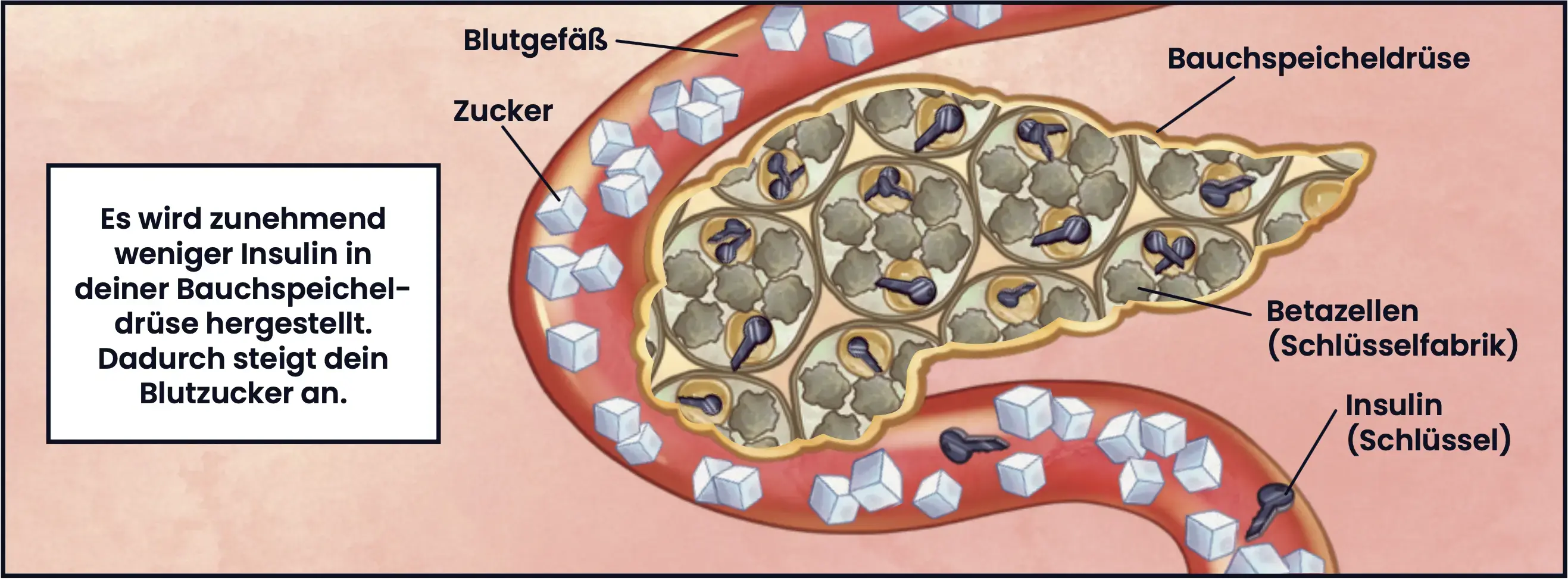 Illustration: Blutgefäß, Zucker, Betazellen (Schlüsselfabrik), Insulin (Schlüssel. Es wird zunehmend weniger Insulin in deiner Bauchspeicheldrüse hergestellt. Dadurch steigt an dein Blutzucker an.
