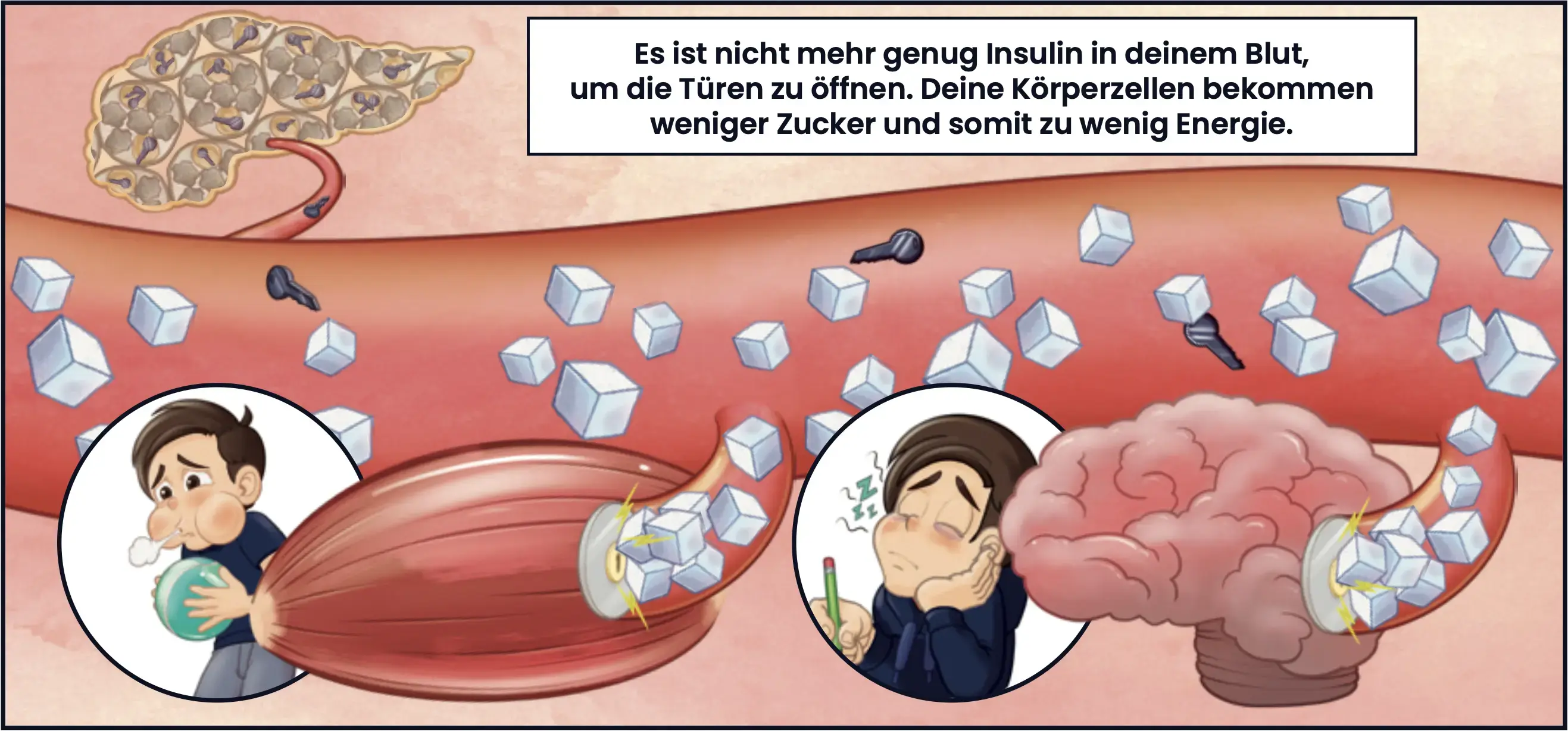 Illustration: Es ist nicht mehr genug Insulin in deinem Blut, um die Türen zu öffnen. Deine körperzellen bekommen weniger Zucker und somit zu wenig Energie.